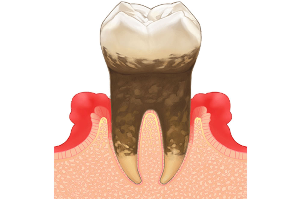 歯周病予防・歯周病治療